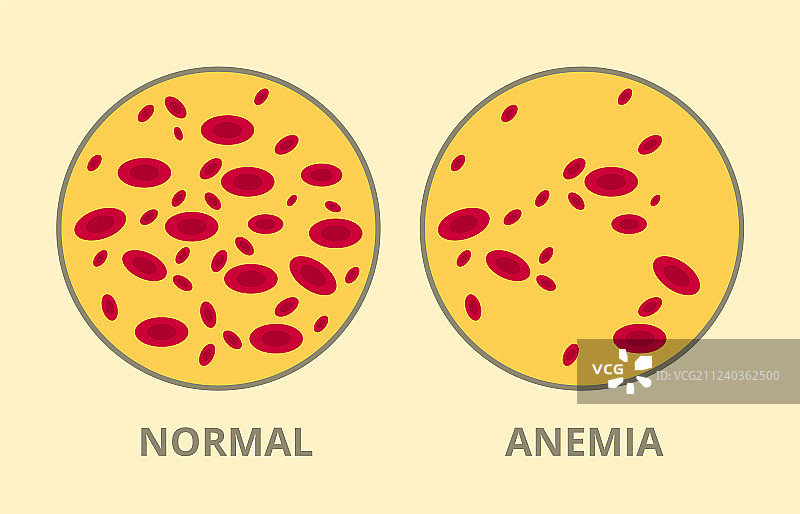 比较正常血细胞和贫血图片素材