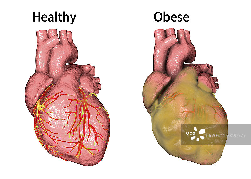 健康和肥胖的心脏，说明图片素材