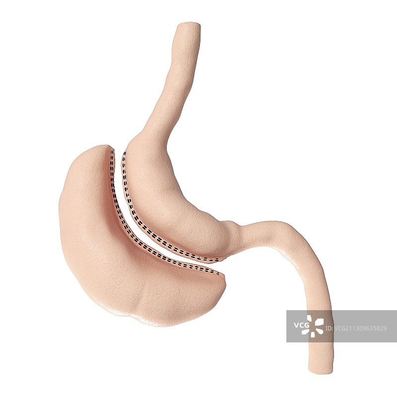 图示:胃垂直袖切除术图片素材
