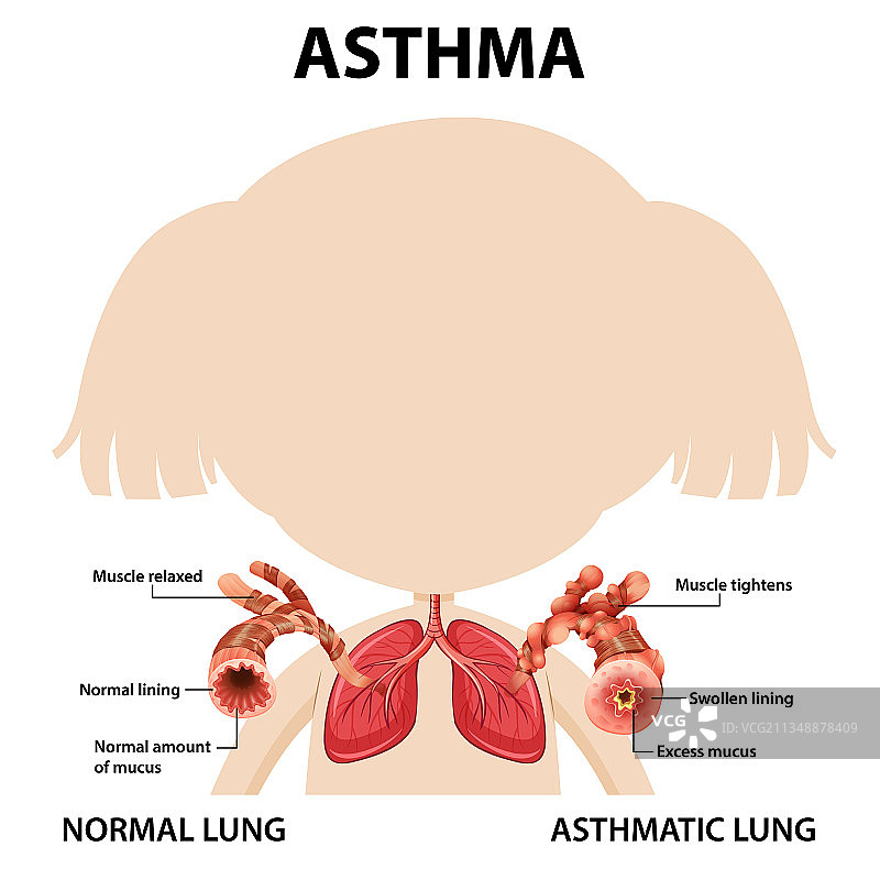 正常肺和哮喘肺的哮喘图图片素材