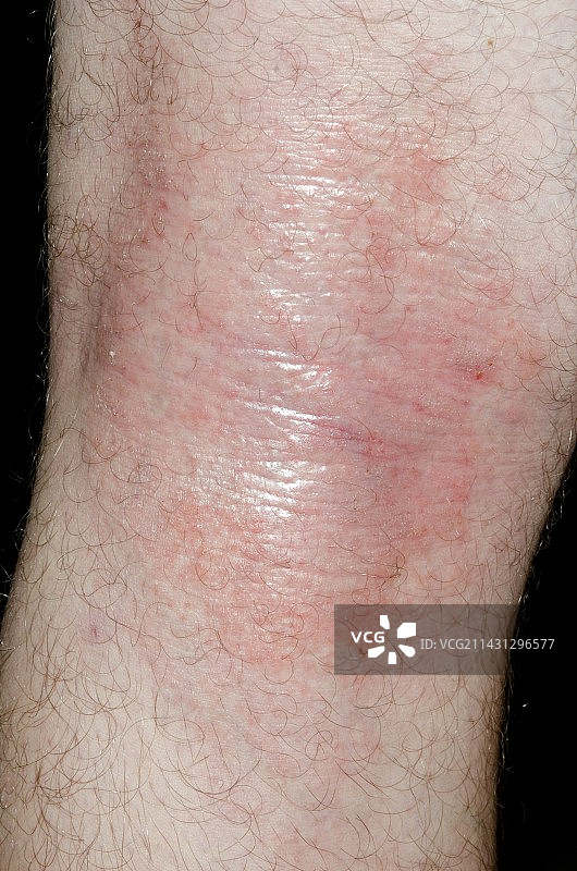 膝盖后面的特应性湿疹图片素材