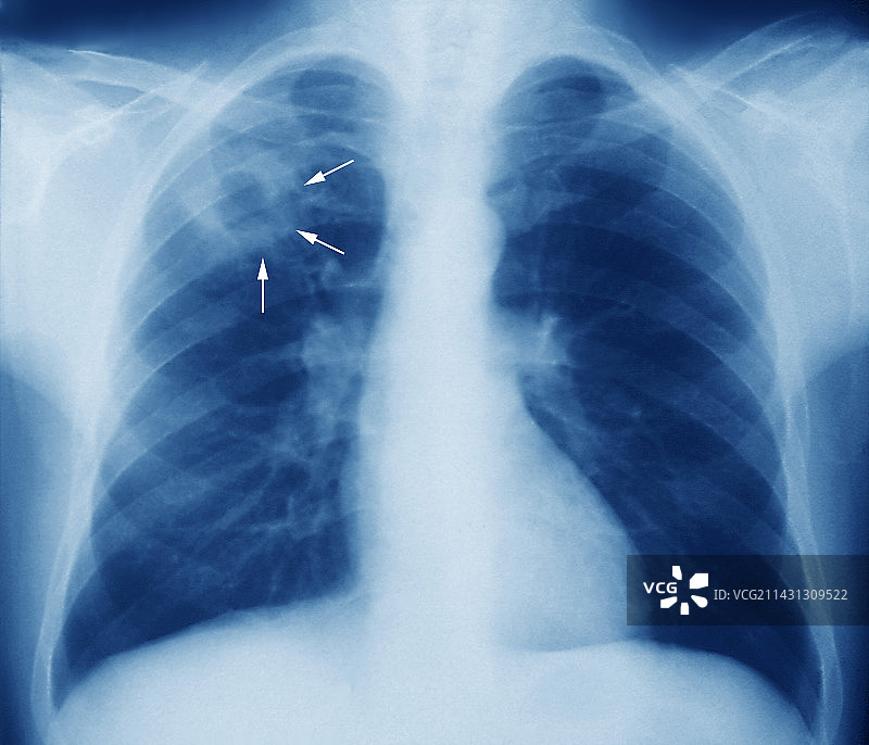 肺结核、x射线图片素材
