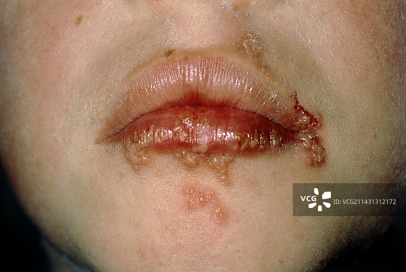 患有单纯疱疹的女孩嘴唇破裂图片素材