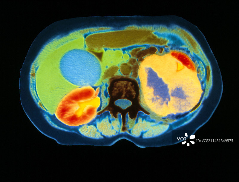 CT扫描显示肾癌(轴向切片)图片素材