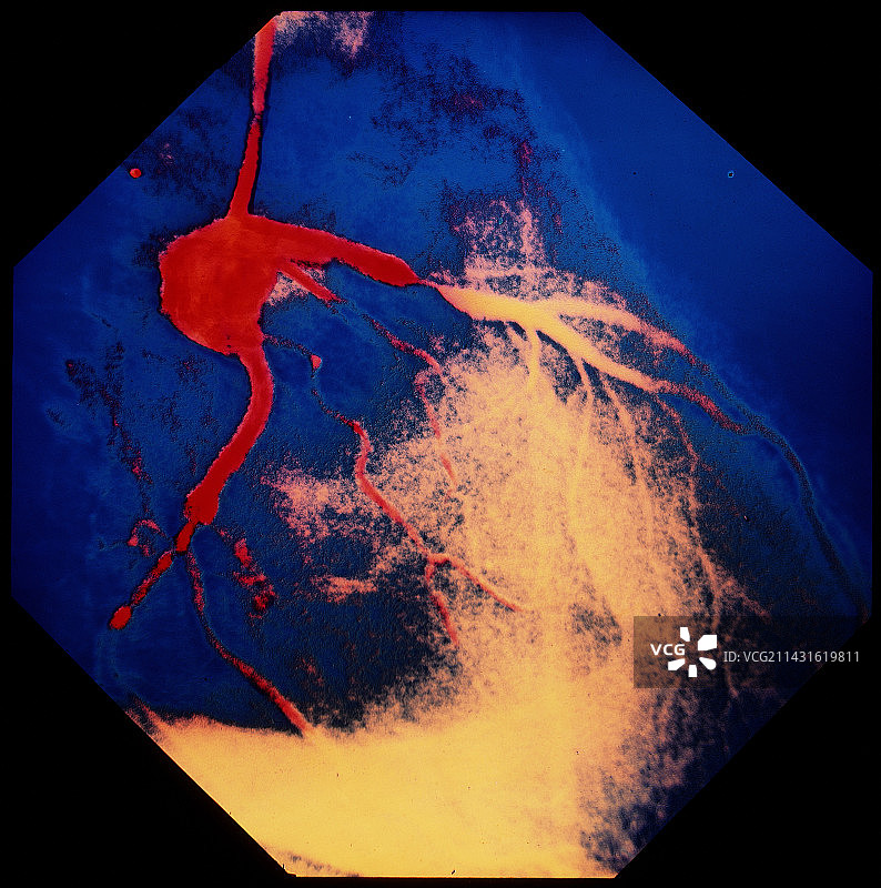 冠状动脉狭窄的彩色血管造影图片素材