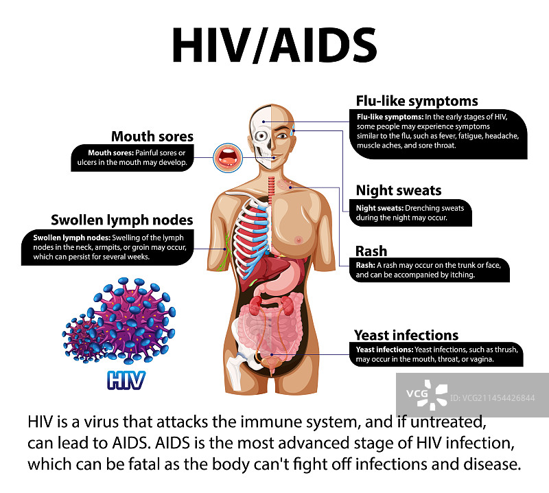艾滋病病毒对人体免疫系统的影响图片素材