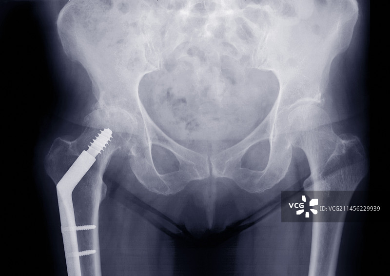 骨盆与镀板腿骨，x光片图片素材