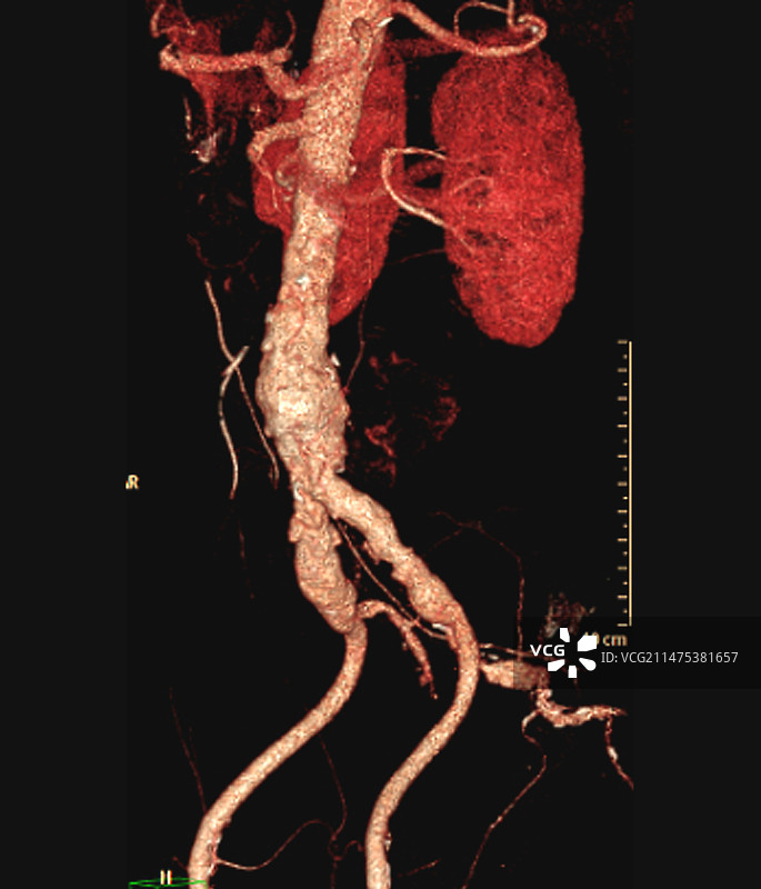 胆固醇栓塞，3D CT血管造影图片素材