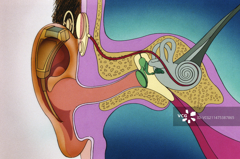 人工耳蜗，插图图片素材