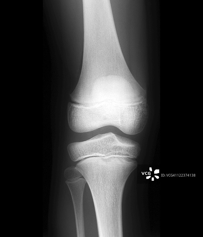 正常孩子的膝盖，x光片图片素材