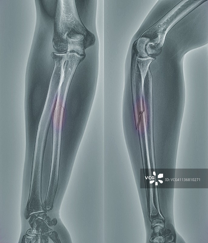 手臂骨折,x射线图片素材