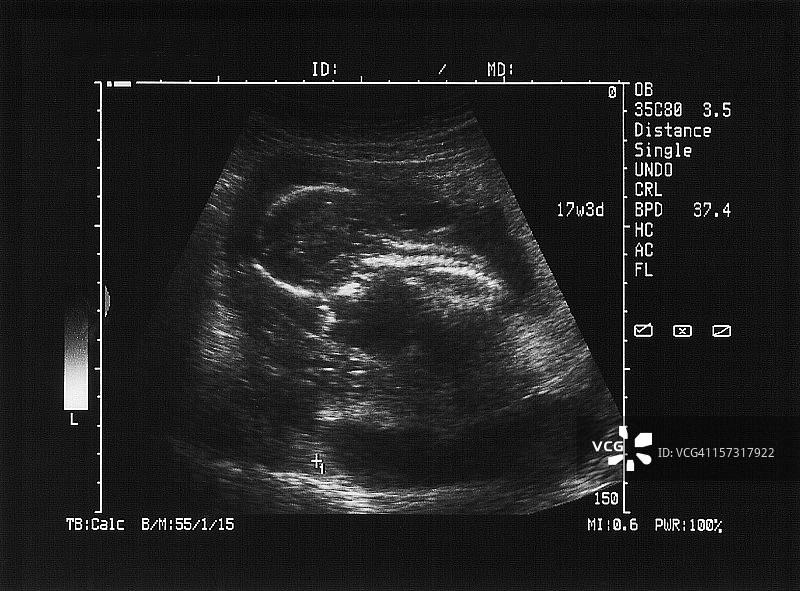 人类胚胎的超声波图像图片素材