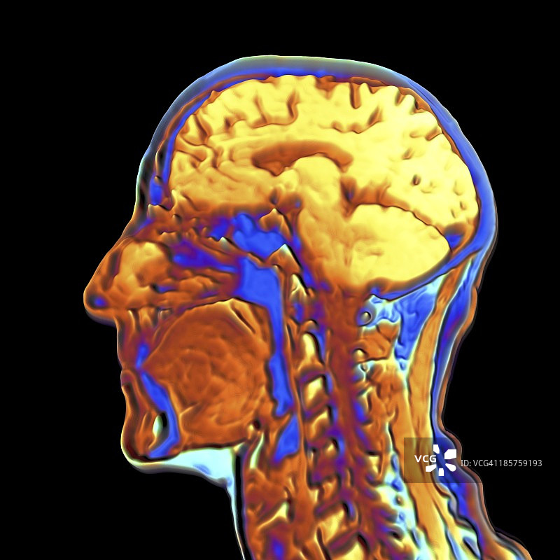 人类头部的彩色核磁共振扫描图片素材