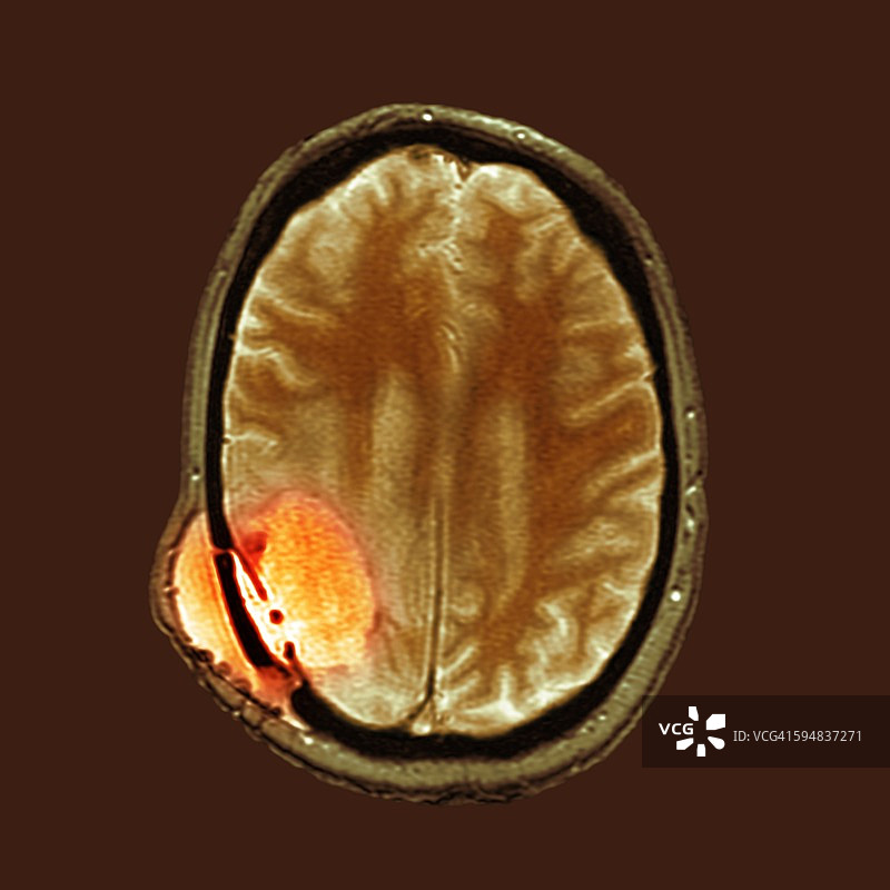 脑癌手术后，核磁共振扫描图片素材