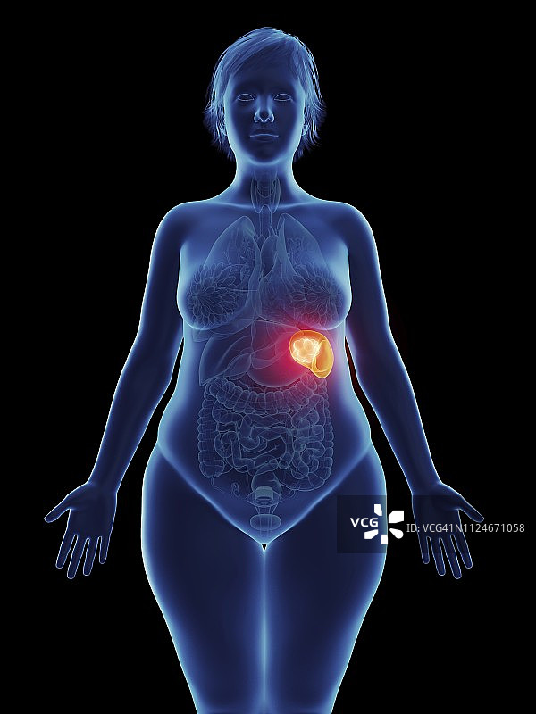 图示:一个妇女的脾脏肿瘤图片素材