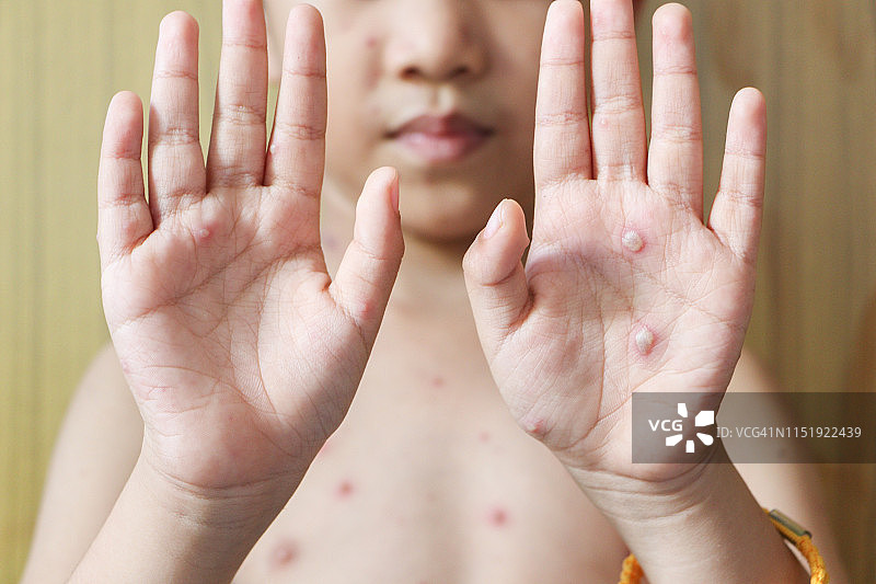 小男孩身上长了水痘。水痘是一种由水痘带状疱疹病毒引起的感染。它最初是起源于面部和躯干的水疱状皮疹图片素材