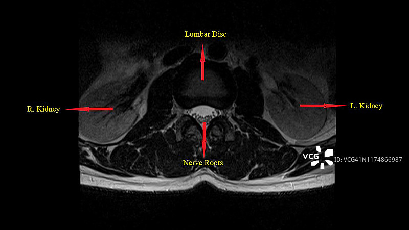 腰椎MRI(磁共振)下背部疼痛成像图片素材