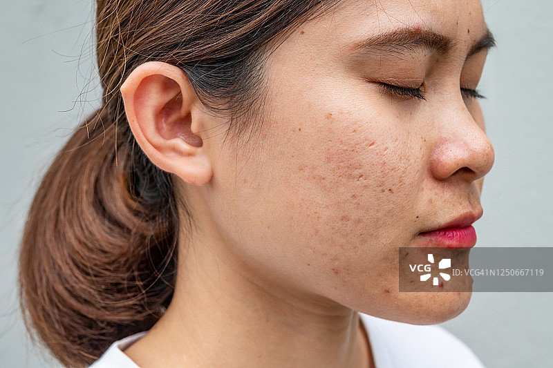侧面特写的亚洲妇女的脸有各种各样的问题在她的皮肤上(如痤疮，丘疹，毛孔和黄褐斑等)。图片素材
