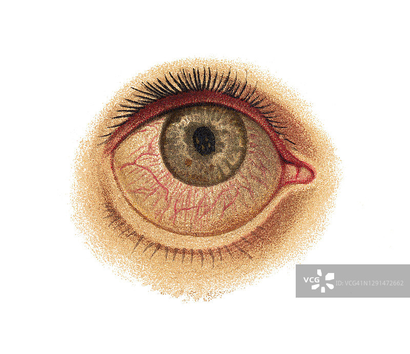 古老的眼睛感染和疾病，角膜炎和虹膜炎雕刻插图图片素材