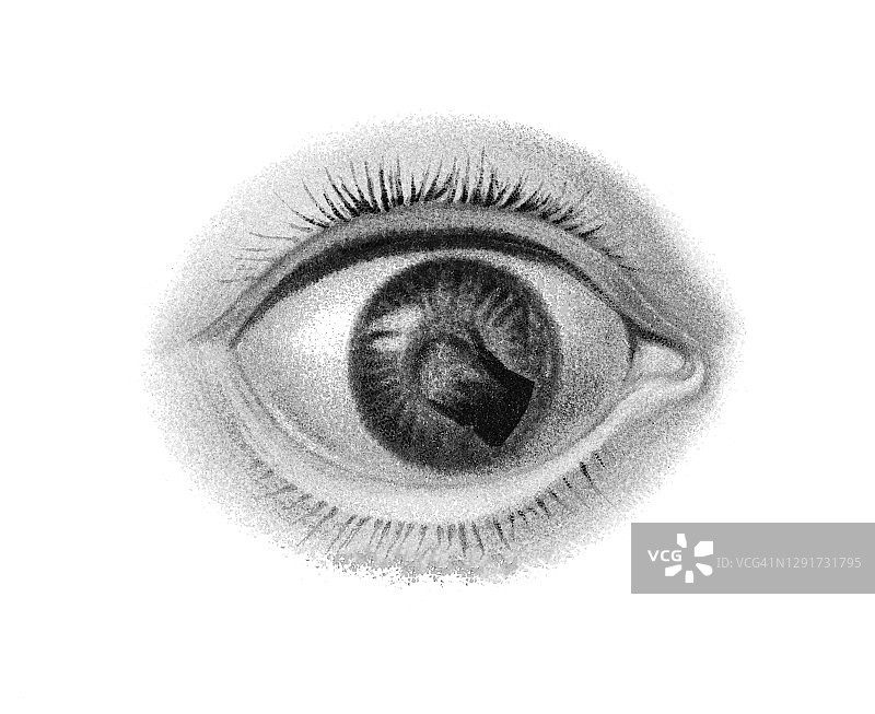 古老的眼睛感染和疾病雕刻插图，角膜中央不透明处的人工瞳孔形成(虹膜切开术)图片素材