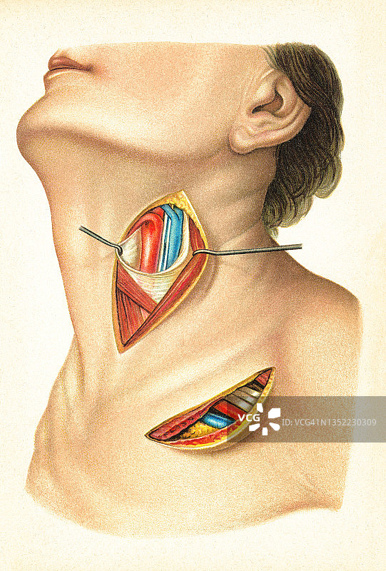 旧彩色印刷插图的外科手术，切割皮肤和内部器官图片素材