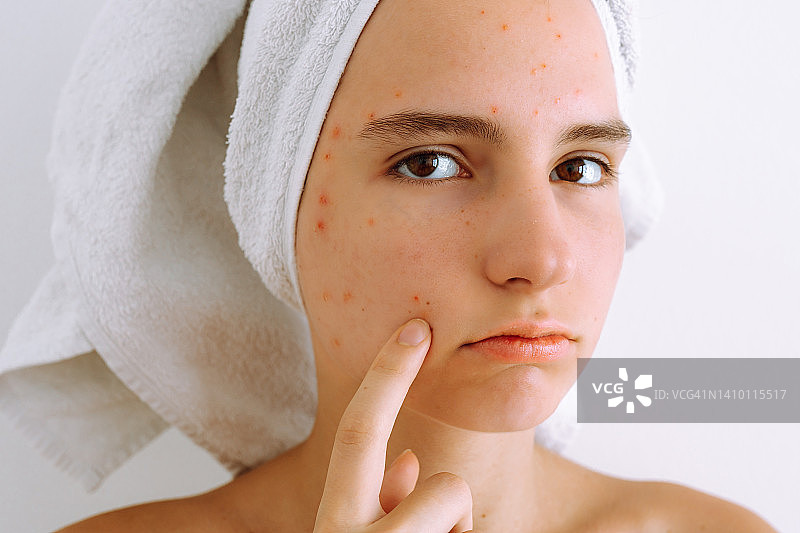 青少年皮肤问题，面部皮肤清洁的美容程序，去除黑斑和痘痘图片素材
