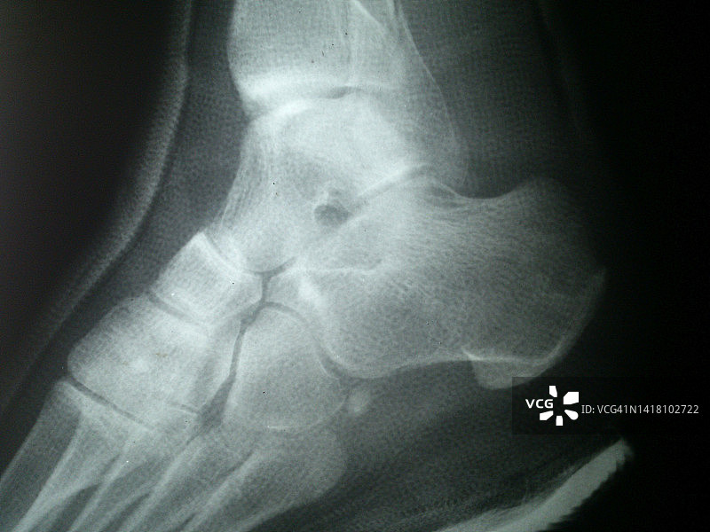 脚踝骨折X光片图片素材
