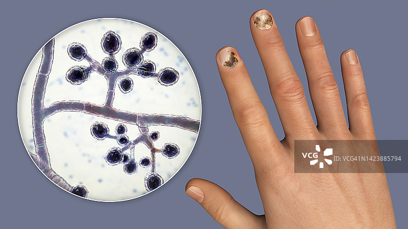 真菌指甲感染，插图图片素材