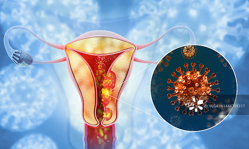 子宫或子宫癌。医学概念是癌细胞在女性生殖系统中扩散。三维演示图片素材