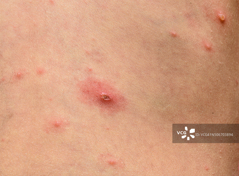 水痘带状疱疹病毒或水痘泡疹对儿童、婴儿图片素材