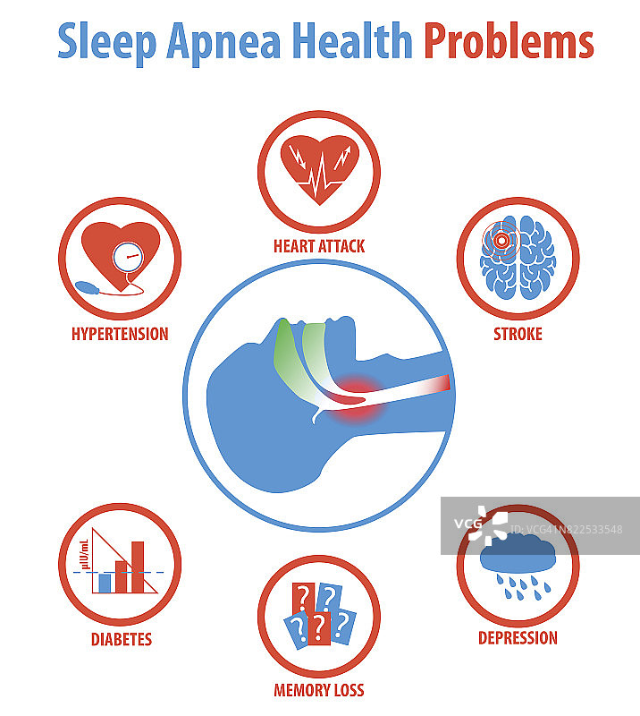 睡眠呼吸暂停:治疗、原因、症状和健康问题。矢量插图。图片素材