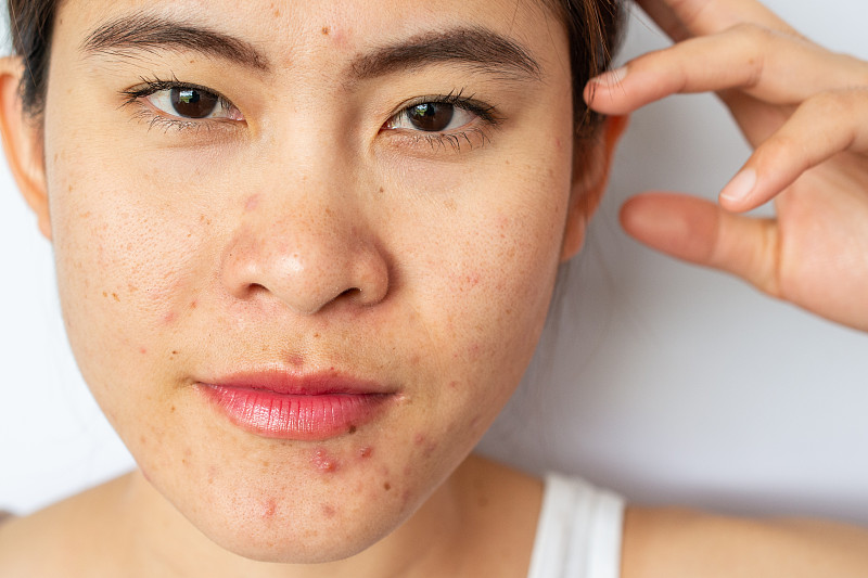 近距离的女人面对痤疮和疤痕的问题从痤疮炎症(丘疹和脓疱)在她的脸上和她看相机。图片素材