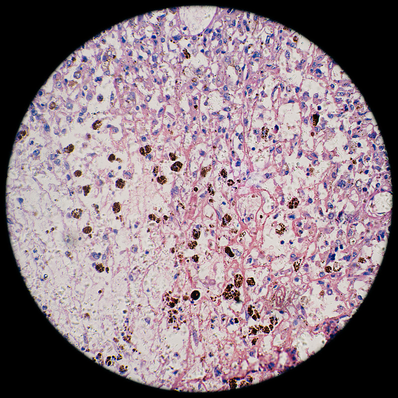 显微镜下观察人类黑色素瘤癌细胞图片素材