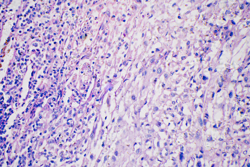 人类黑色素瘤癌细胞的显微照片摄影图片下载