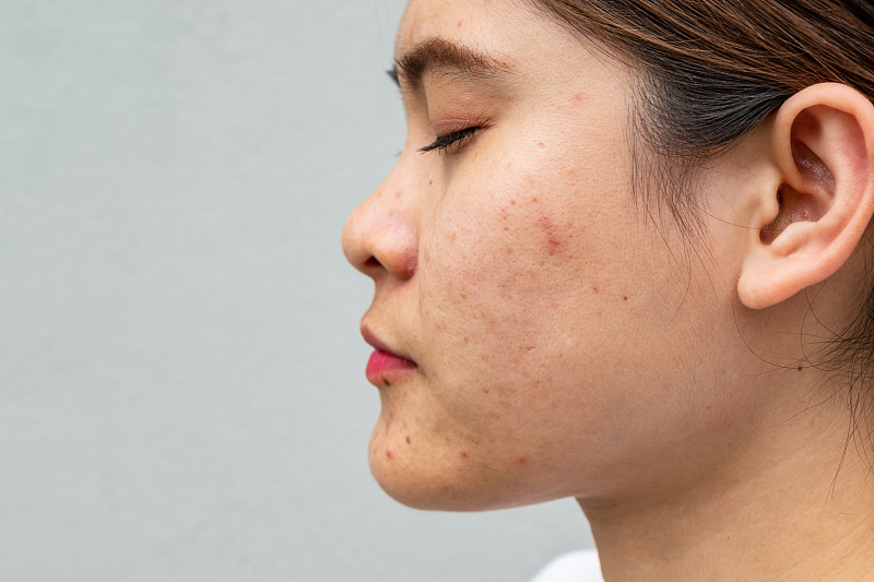 侧面特写的亚洲妇女的脸有各种各样的问题在她的皮肤上(如痤疮，丘疹，毛孔和黄褐斑等)。图片下载