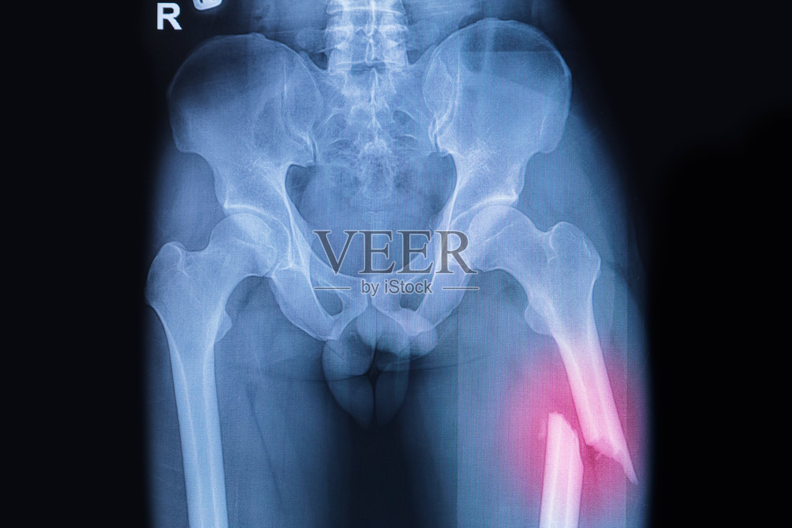 股骨骨折，大腿骨折x光片照片摄影图片