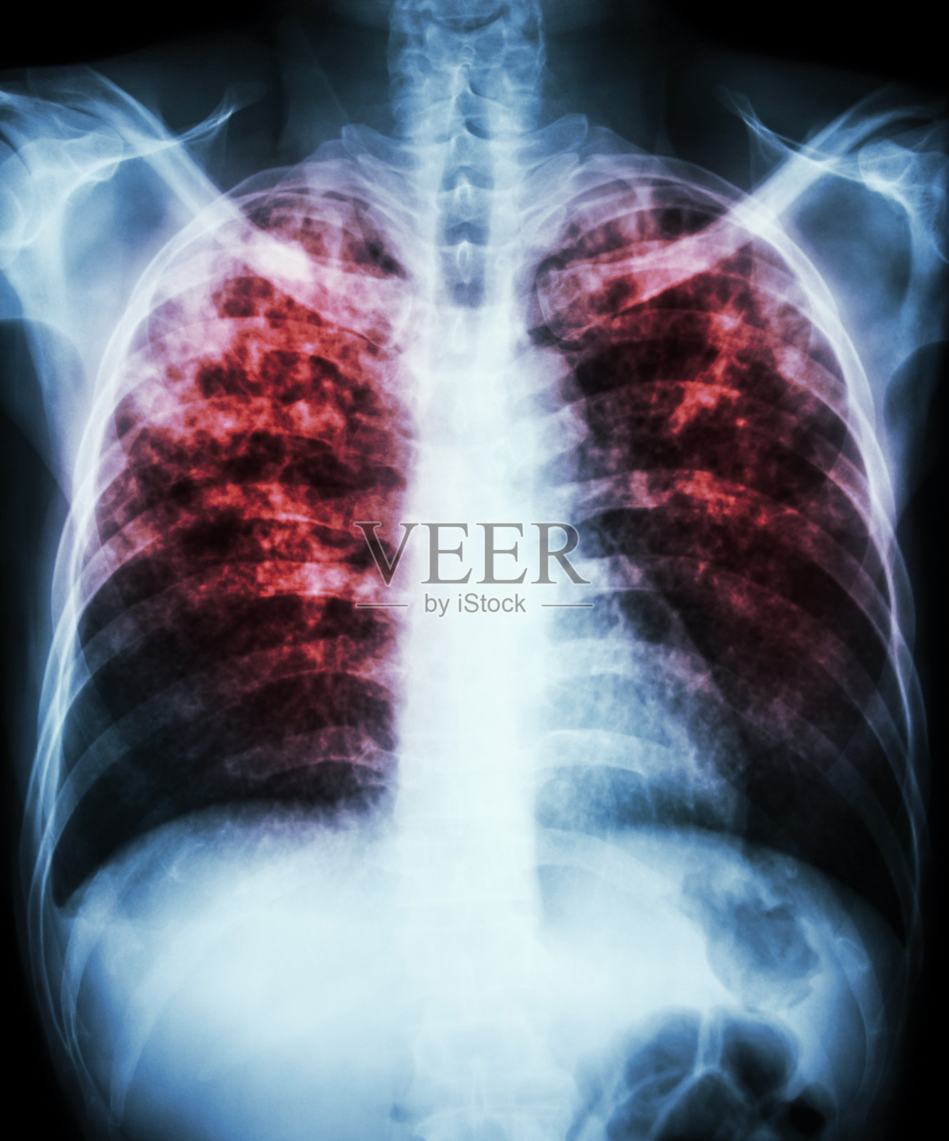 肺结核照片摄影图片