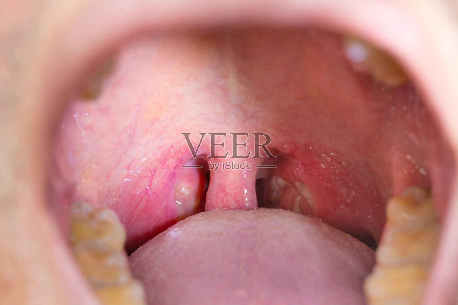 扁桃体的喉咙照片摄影图片