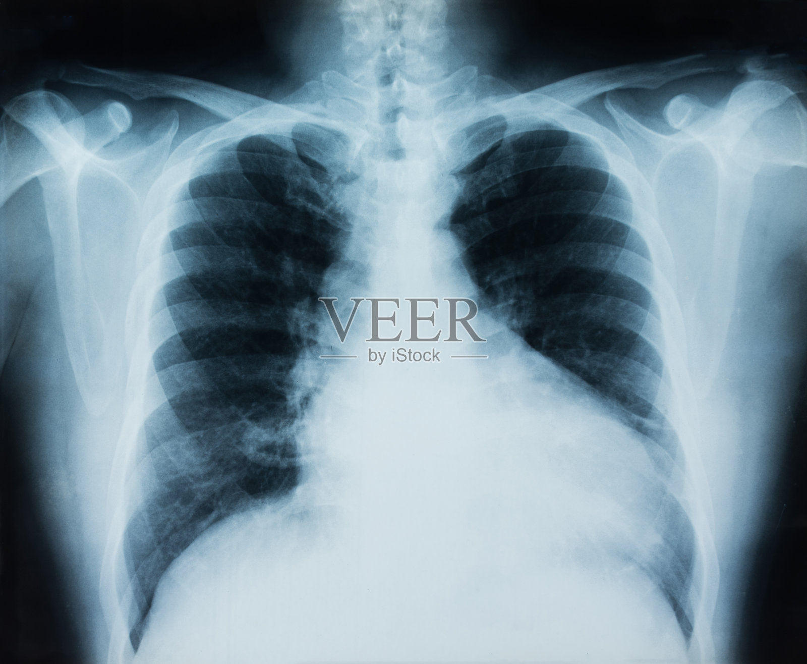 肺部x光照片摄影图片
