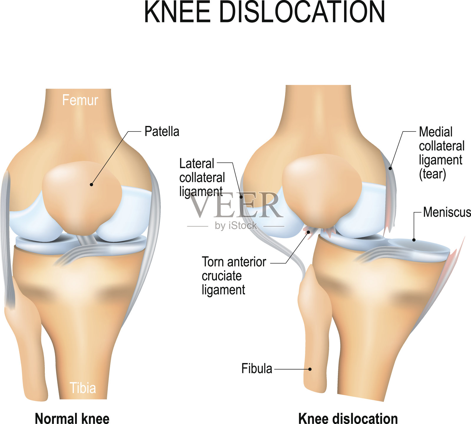 膝关节脱位及正常膝关节插画图片素材
