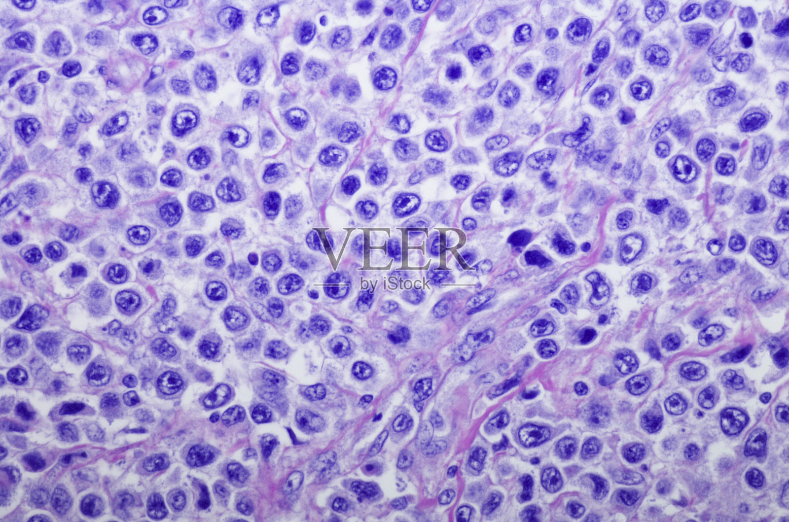 胃弥漫性大b细胞淋巴瘤照片摄影图片