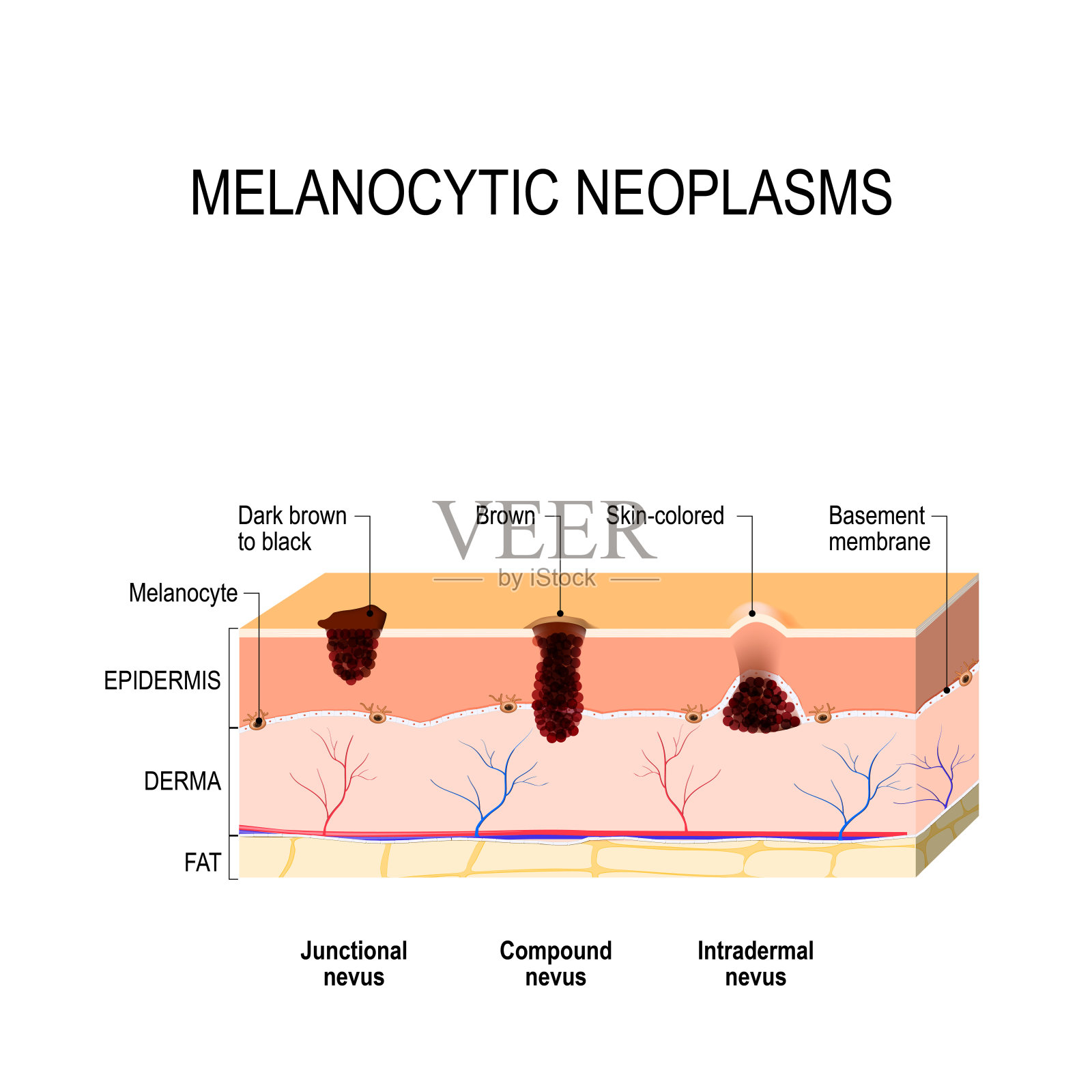 Melanocytic痣。胎记，痣和痣的区别插画图片素材