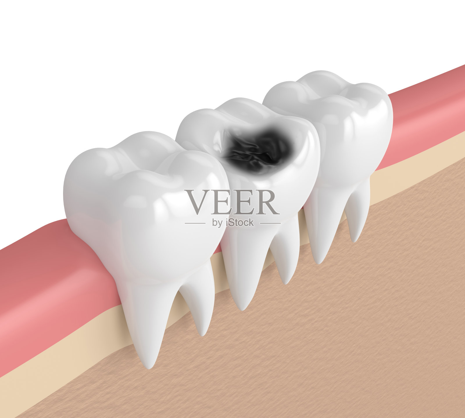 牙齿的3d渲染牙龈与龋齿插画图片素材