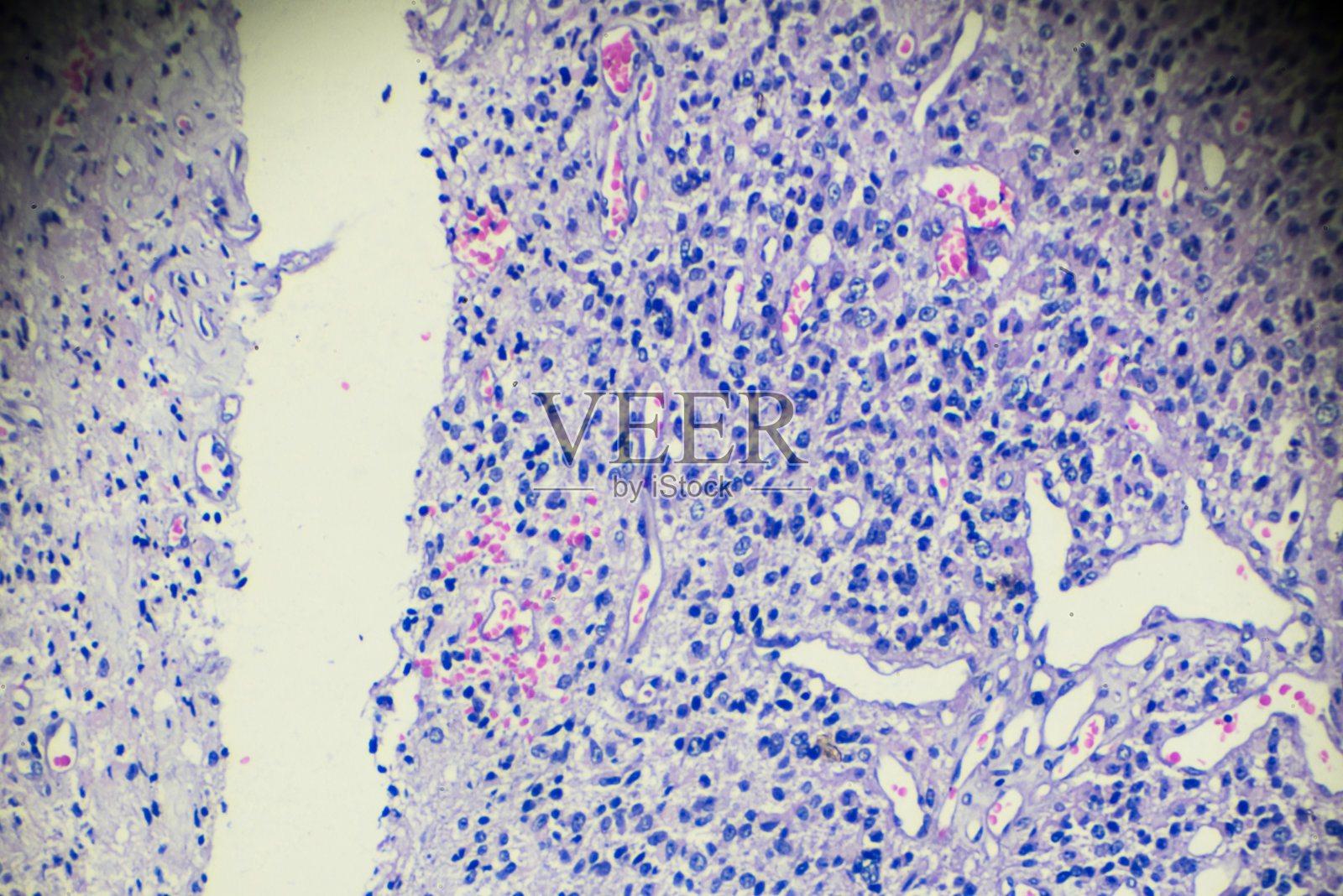 显微镜下观察睾丸生殖细胞瘤照片摄影图片