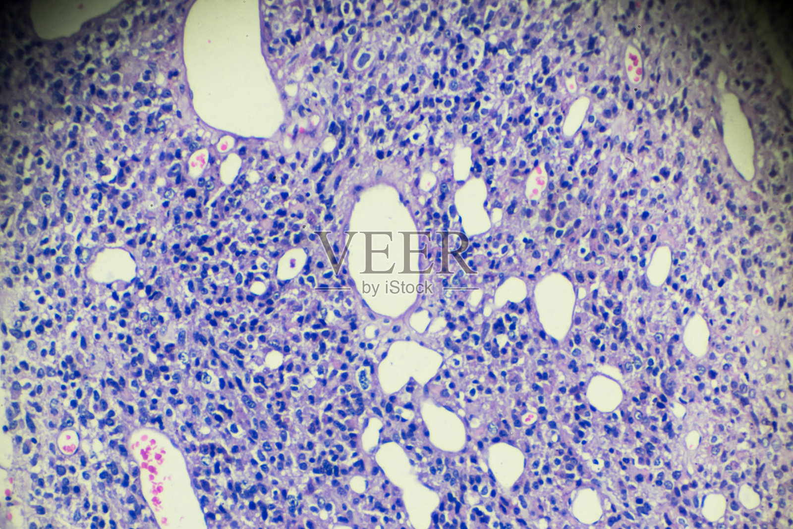 显微镜下观察睾丸生殖细胞瘤照片摄影图片