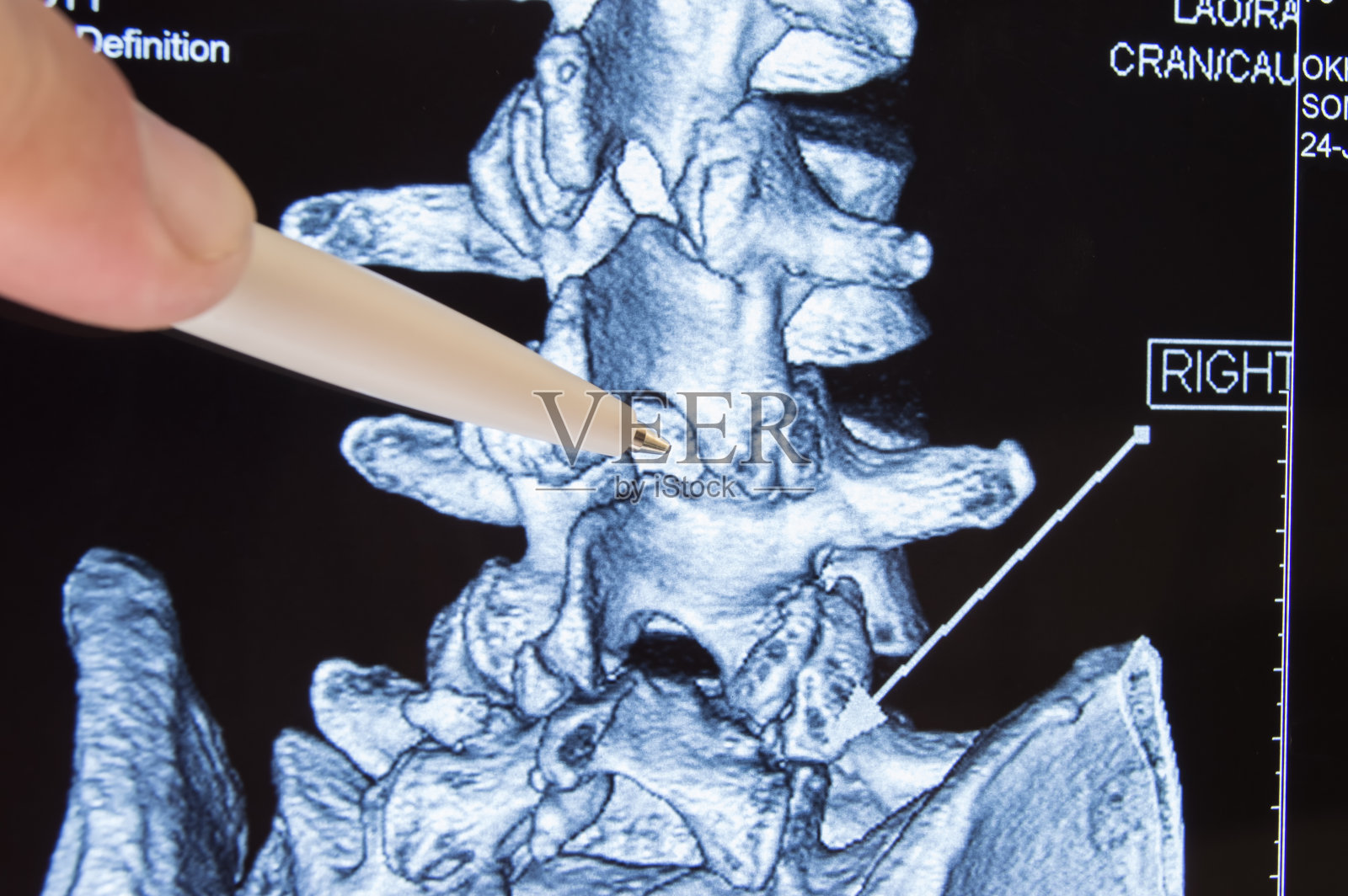 医生在CT上显示MRI扫描置于脊柱椎体之间，这是硬膜外麻醉或脊柱穿刺的过程。分娩或神经外科手术时的硬膜外麻醉照片摄影图片