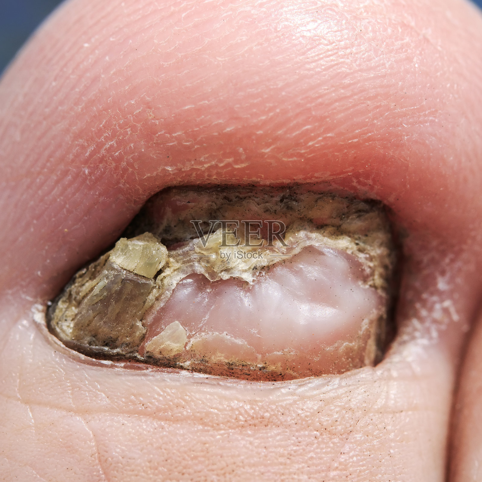 指甲被一个可怕的和讨厌的疾病真菌击中特写照片摄影图片