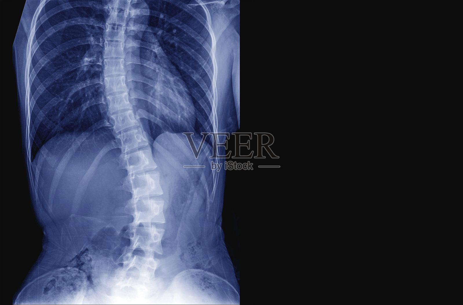 青少年患者脊柱x线影像显示年轻人脊柱侧凸和脊柱弯曲。过程在蓝色色调和有复制空间，医学概念。照片摄影图片