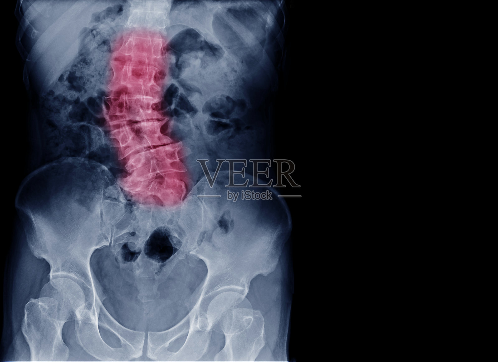老年患者脊柱x线影像显示老年人脊柱侧凸和脊柱弯曲。处理在蓝色色调的脊椎标记在红色和有拷贝空间，医学概念。照片摄影图片