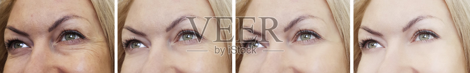 女性眼部皱纹治疗前后照片摄影图片